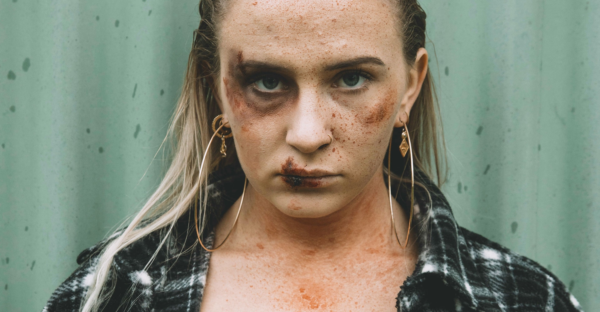Assault in Shared Accommodation Leading to Multiple Facial Fractures winston-solicitors-abuse-assault-cica-assault-in-shared-accommodation